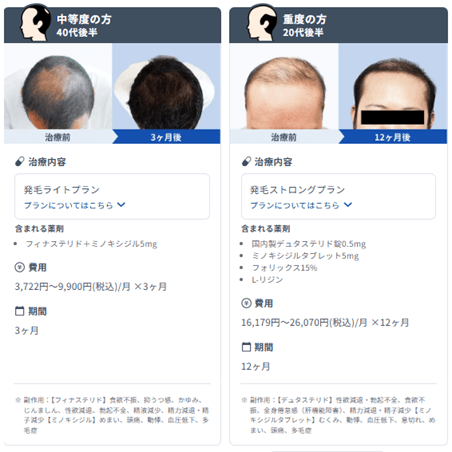 DMM AGAの症例写真では3ヶ月後と12ヶ月後で発毛効果が確認できる